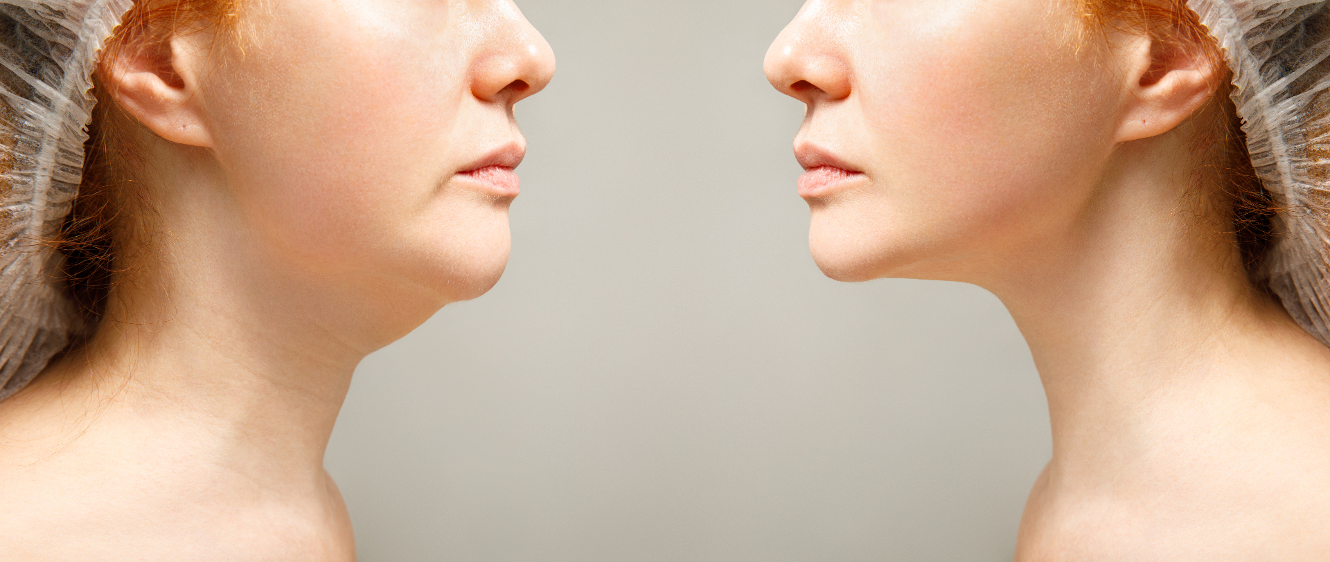 Double Chin / Submental Fat Reduction — patient before and after treatment
